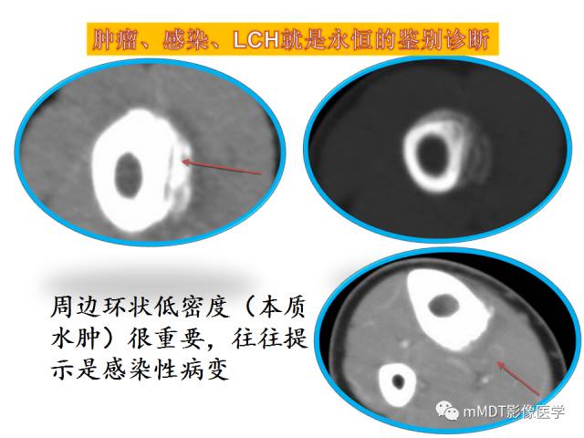【PPT】骨感染性病变的诊断思路