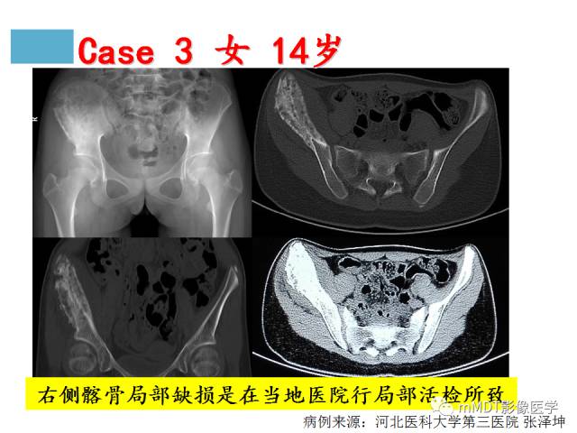【PPT】骨感染性病变的诊断思路