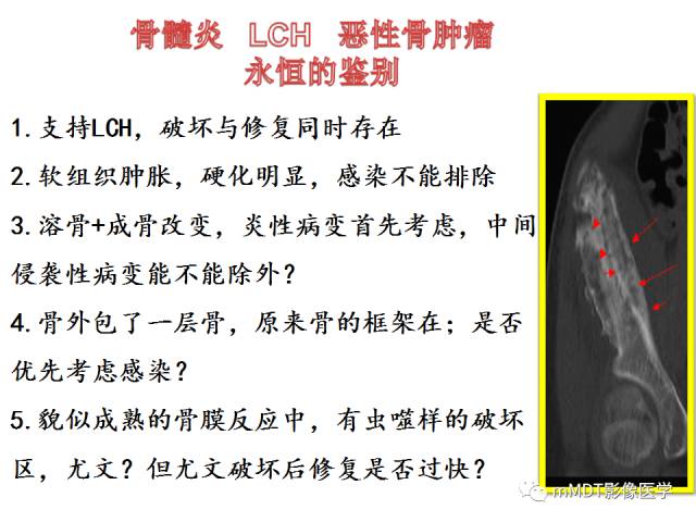 【PPT】骨感染性病变的诊断思路