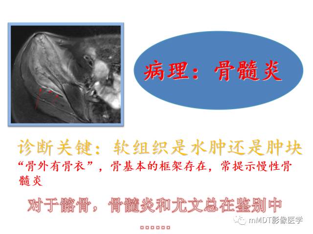 【PPT】骨感染性病变的诊断思路