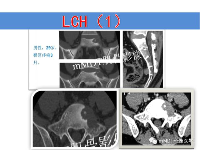 【PPT】骨感染性病变的诊断思路