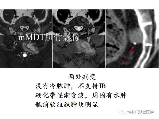 【PPT】骨感染性病变的诊断思路