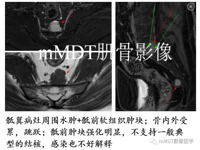 【PPT】骨感染性病变的诊断思路
