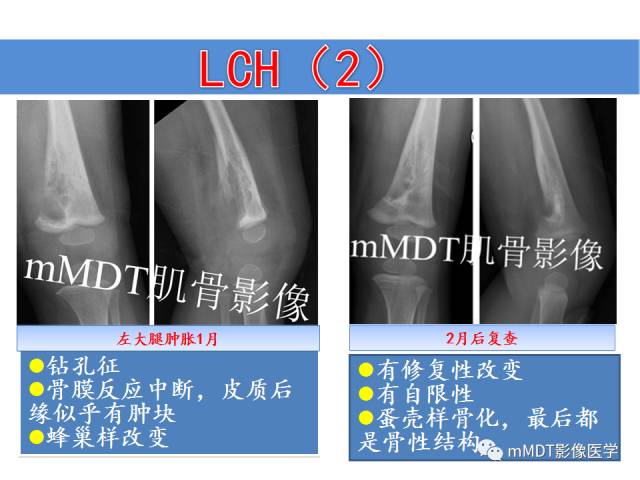 【PPT】骨感染性病变的诊断思路