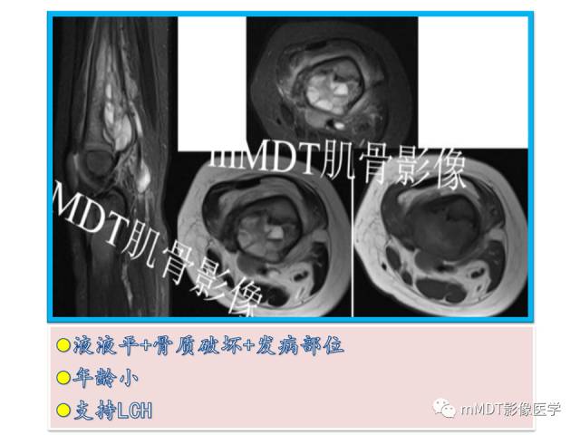 【PPT】骨感染性病变的诊断思路