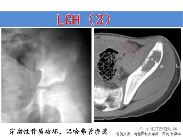 【PPT】骨感染性病变的诊断思路