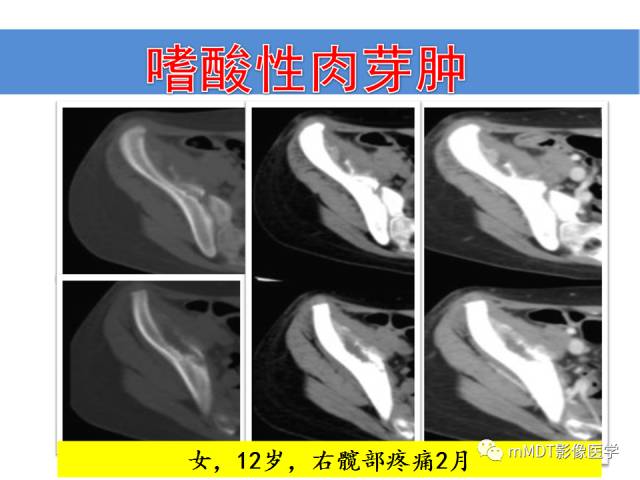 【PPT】骨感染性病变的诊断思路