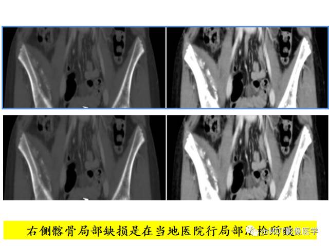 【PPT】骨感染性病变的诊断思路