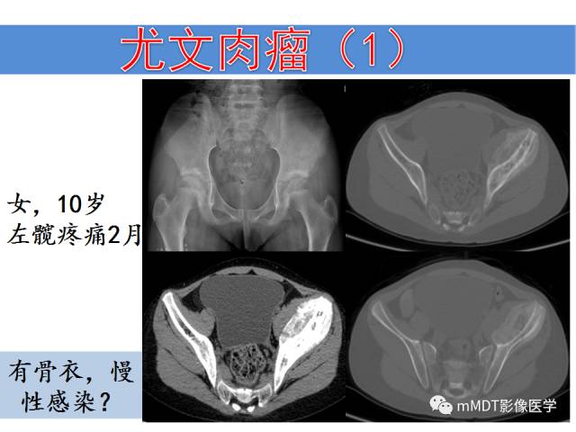 【PPT】骨感染性病变的诊断思路