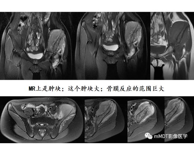 【PPT】骨感染性病变的诊断思路