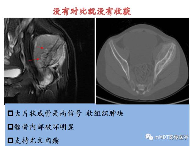 【PPT】骨感染性病变的诊断思路