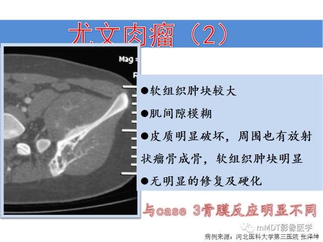【PPT】骨感染性病变的诊断思路