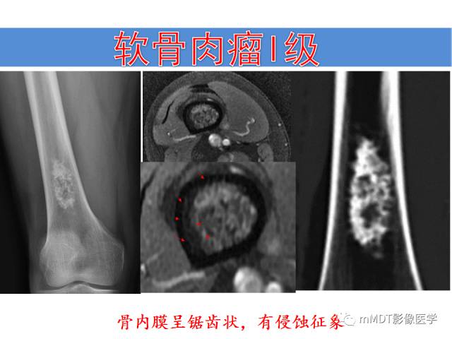 【PPT】骨感染性病变的诊断思路