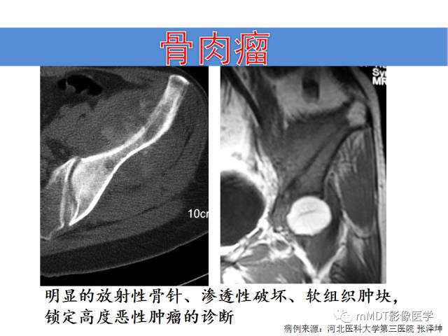 【PPT】骨感染性病变的诊断思路