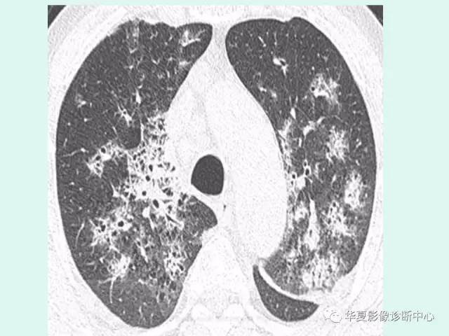 【病例】肺淋巴瘤一例CT