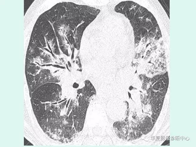 【病例】肺淋巴瘤一例CT