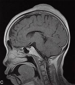 【病例】颅顶血管肉瘤1例MR影像表现分析 【病例】颅顶血管肉瘤1例MR影像表现分析