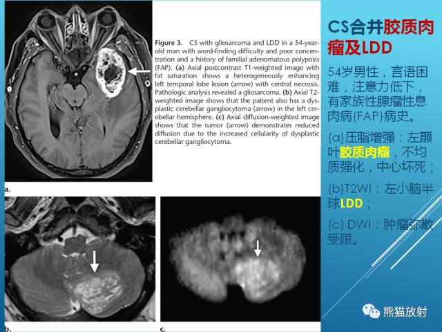 【PPT】中枢神经系统肿瘤相关的遗传综合征 【PPT】中枢神经系统肿瘤相关的遗传综合征