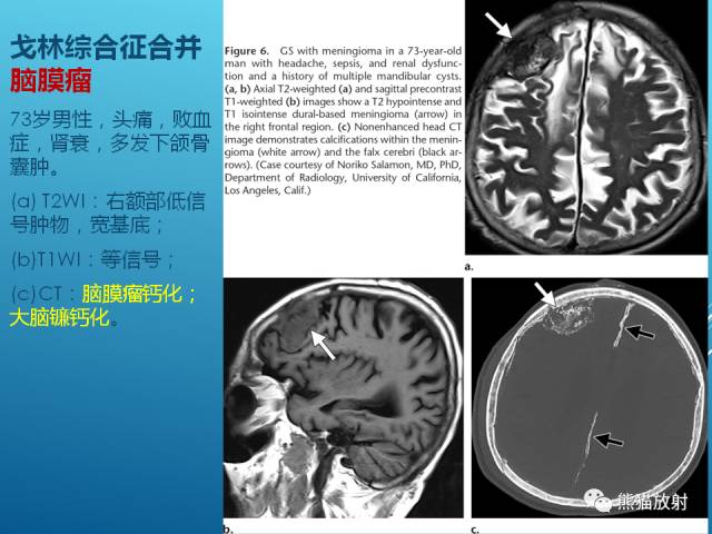 【PPT】中枢神经系统肿瘤相关的遗传综合征 【PPT】中枢神经系统肿瘤相关的遗传综合征