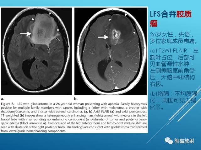 【PPT】中枢神经系统肿瘤相关的遗传综合征 【PPT】中枢神经系统肿瘤相关的遗传综合征