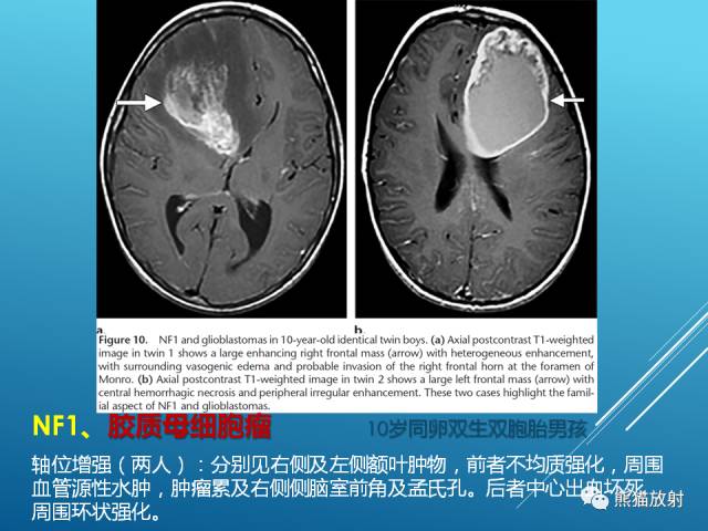 【PPT】中枢神经系统肿瘤相关的遗传综合征 【PPT】中枢神经系统肿瘤相关的遗传综合征