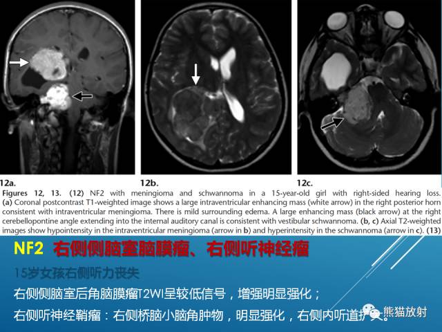 【PPT】中枢神经系统肿瘤相关的遗传综合征 【PPT】中枢神经系统肿瘤相关的遗传综合征