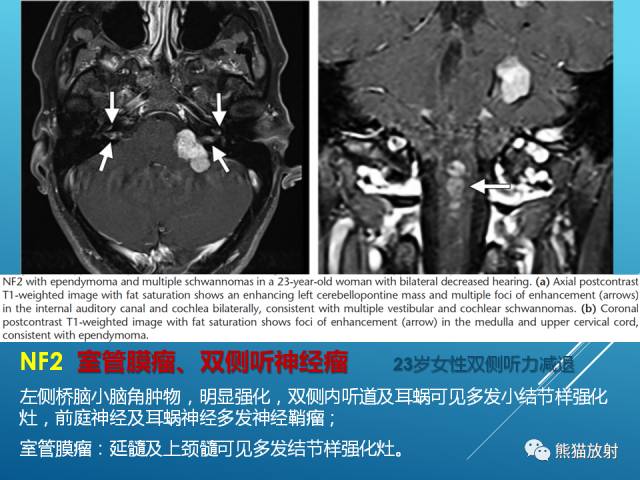 【PPT】中枢神经系统肿瘤相关的遗传综合征 【PPT】中枢神经系统肿瘤相关的遗传综合征