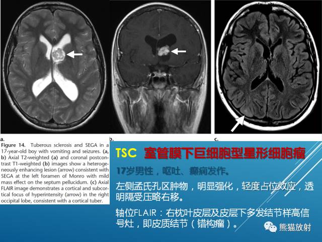 【PPT】中枢神经系统肿瘤相关的遗传综合征 【PPT】中枢神经系统肿瘤相关的遗传综合征