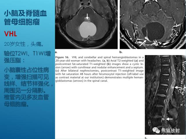 【PPT】中枢神经系统肿瘤相关的遗传综合征 【PPT】中枢神经系统肿瘤相关的遗传综合征