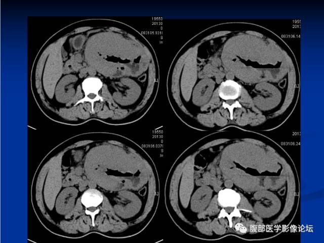 【病例】小肠间质瘤1例CT影像表现与鉴别 【病例】小肠间质瘤1例CT影像表现与鉴别