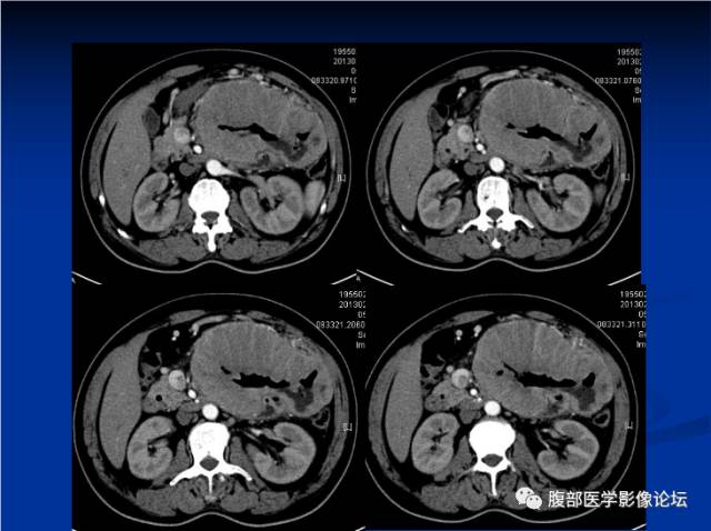 【病例】小肠间质瘤1例CT影像表现与鉴别 【病例】小肠间质瘤1例CT影像表现与鉴别