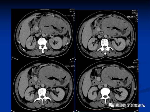 【病例】小肠间质瘤1例CT影像表现与鉴别 【病例】小肠间质瘤1例CT影像表现与鉴别