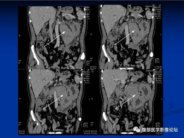 【病例】小肠间质瘤1例CT影像表现与鉴别 【病例】小肠间质瘤1例CT影像表现与鉴别