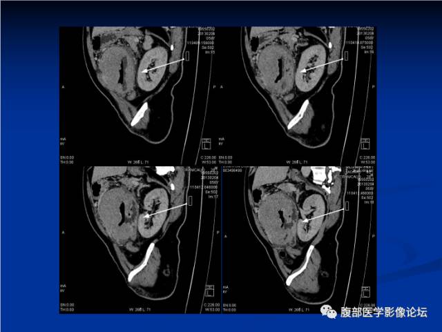 【病例】小肠间质瘤1例CT影像表现与鉴别 【病例】小肠间质瘤1例CT影像表现与鉴别