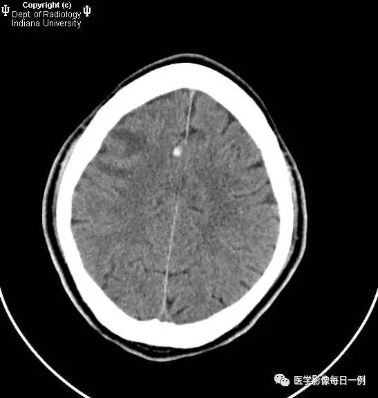 【病例】继发于细菌性心内膜炎的多发感染性栓子性梗塞并转变为出血1例CT 【病例】继发于细菌性心内膜炎的多发感染性栓子性梗塞并转变为出血1例CT