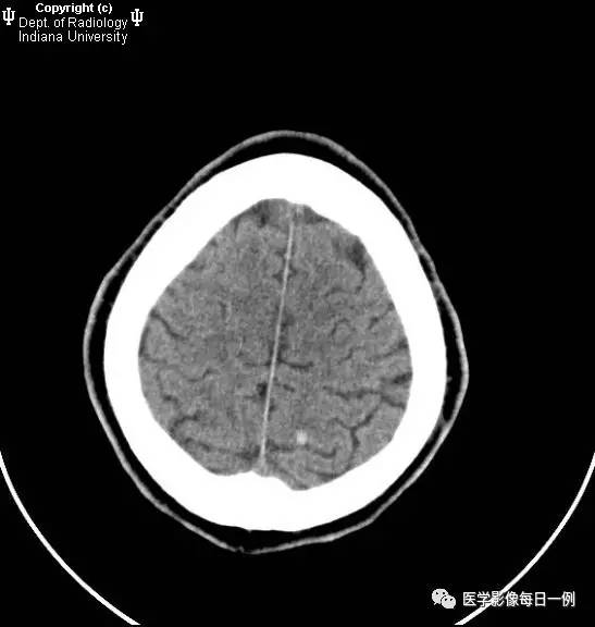 【病例】继发于细菌性心内膜炎的多发感染性栓子性梗塞并转变为出血1例CT 【病例】继发于细菌性心内膜炎的多发感染性栓子性梗塞并转变为出血1例CT