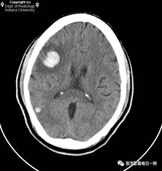 【病例】继发于细菌性心内膜炎的多发感染性栓子性梗塞并转变为出血1例CT