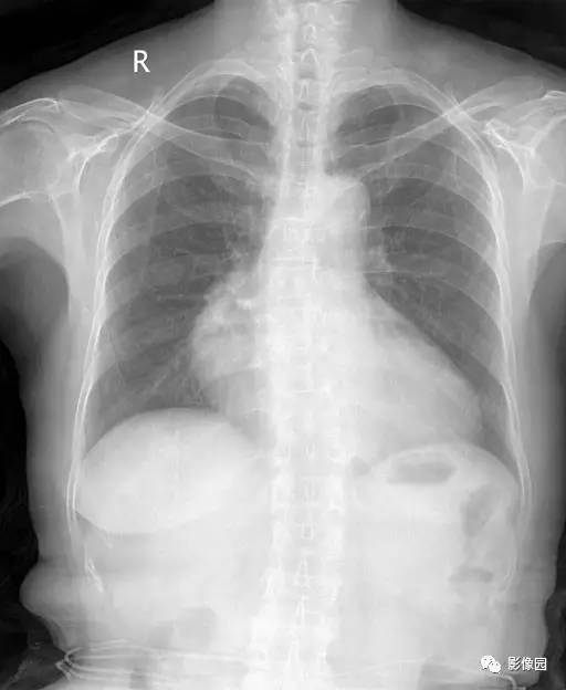 【病例】胸腺瘤1例CT影像表现 【病例】胸腺瘤1例CT影像表现