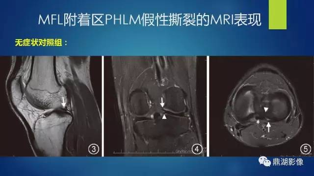【PPT】膝关节板股韧带附着区半月板真、假性撕裂的MRI表现及鉴别诊断