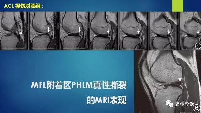【PPT】膝关节板股韧带附着区半月板真、假性撕裂的MRI表现及鉴别诊断