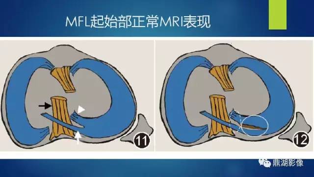 【PPT】膝关节板股韧带附着区半月板真、假性撕裂的MRI表现及鉴别诊断