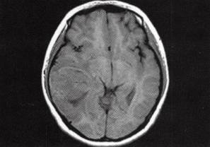 【病例】右颞叶少突胶质细胞瘤1例CT及MR分析 【病例】右颞叶少突胶质细胞瘤1例CT及MR分析