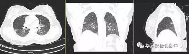肺部子宫内膜异位症
