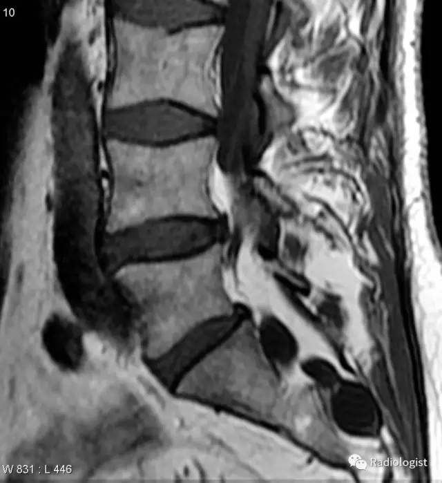 纤维环裂隙(Annular fissures) 纤维环裂隙(Annular fissures)