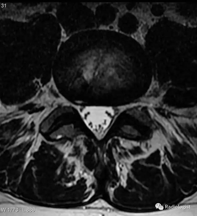 纤维环裂隙(Annular fissures) 纤维环裂隙(Annular fissures)