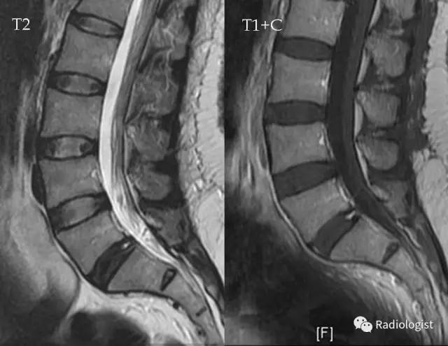 纤维环裂隙(Annular fissures) 纤维环裂隙(Annular fissures)