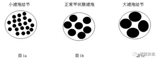 相沙带你走进甲状腺解析：特异度最高的影像学征象