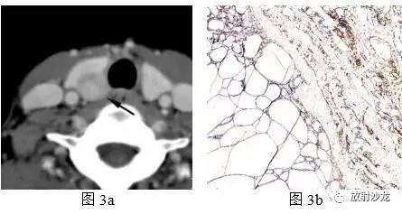相沙带你走进甲状腺解析：特异度最高的影像学征象
