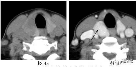 相沙带你走进甲状腺解析：特异度最高的影像学征象