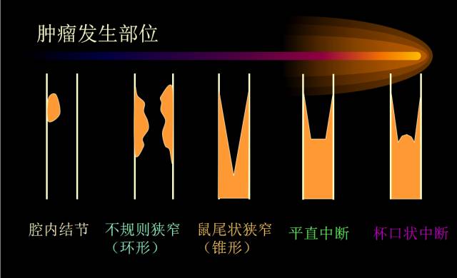 【PPT】肺肿瘤